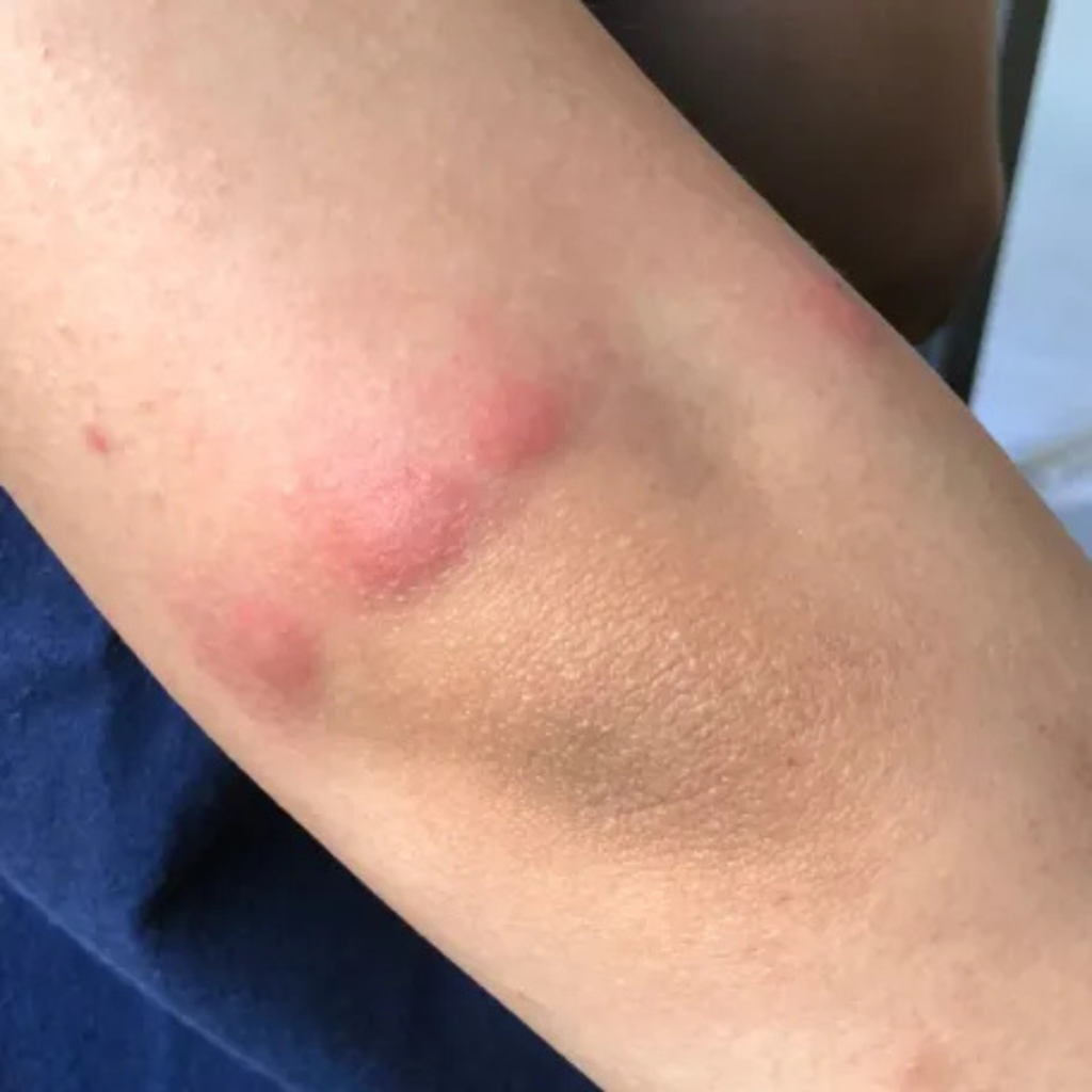 Traitement punaises de lit à Toulon - Extermination professionnelle garantie