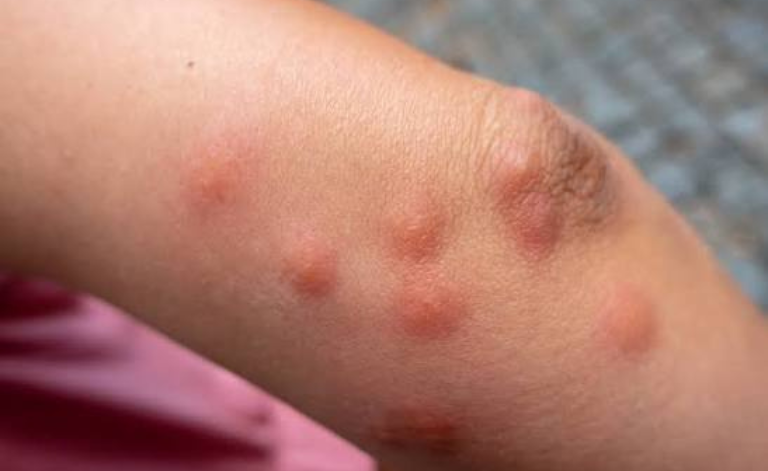 Punaises de lit à Marseille : que faire en cas d'infestation ?